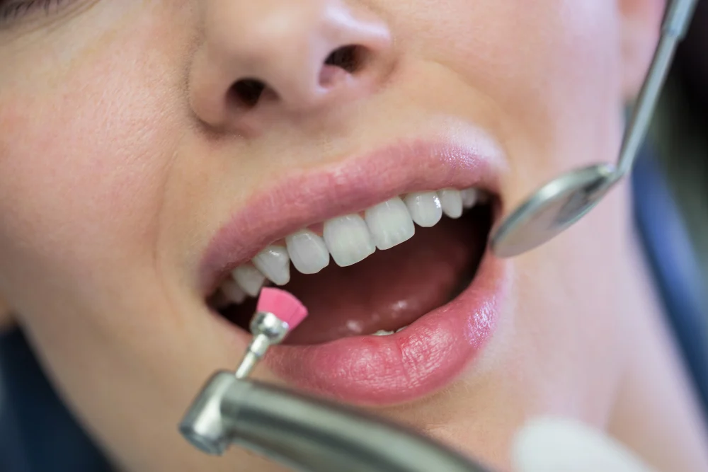 Veneers and Laminates