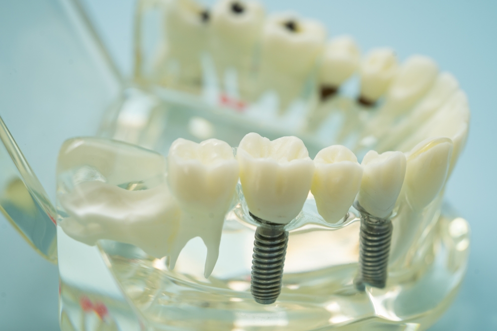 Can Dental Implants Replace All Your Teeth? What to Know About Full-Mouth Implants