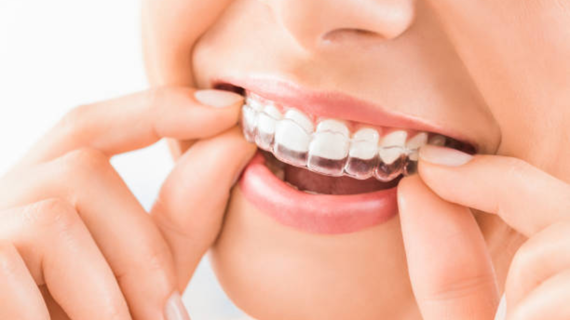 How Much Does Invisalign Cost in the USA? A Complete Guide