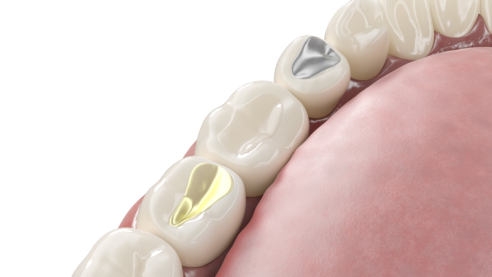 Tooth-Colored vs. Silver Fillings: Which Is Better for Your Smile?